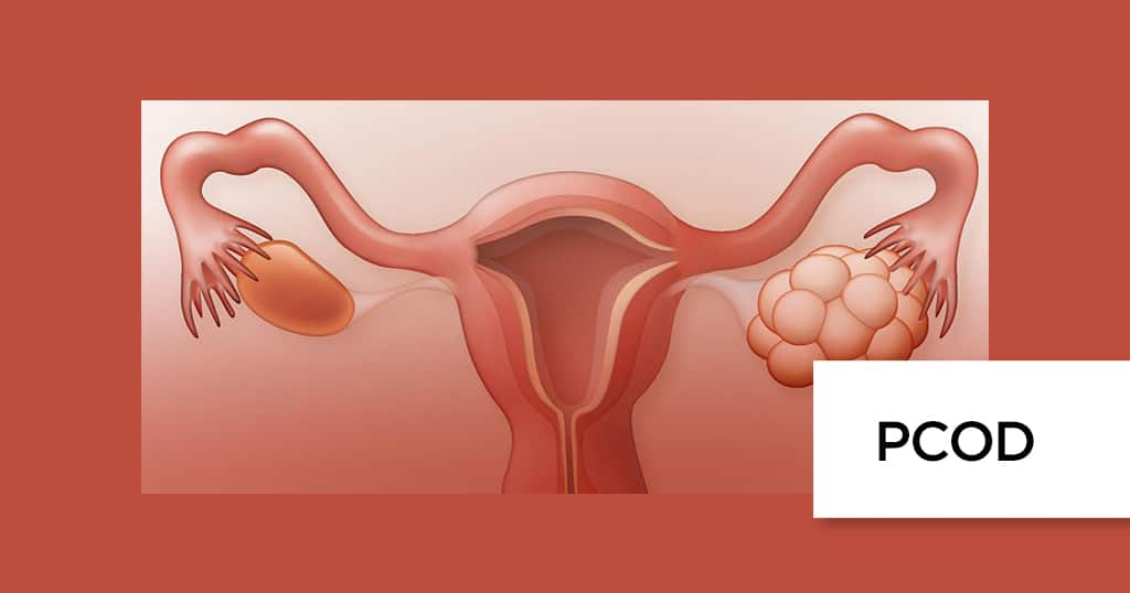 PCOD Polycystic Ovarian Disease Polycystic Ovary Syndrome PCOS 